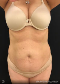 BodyTite