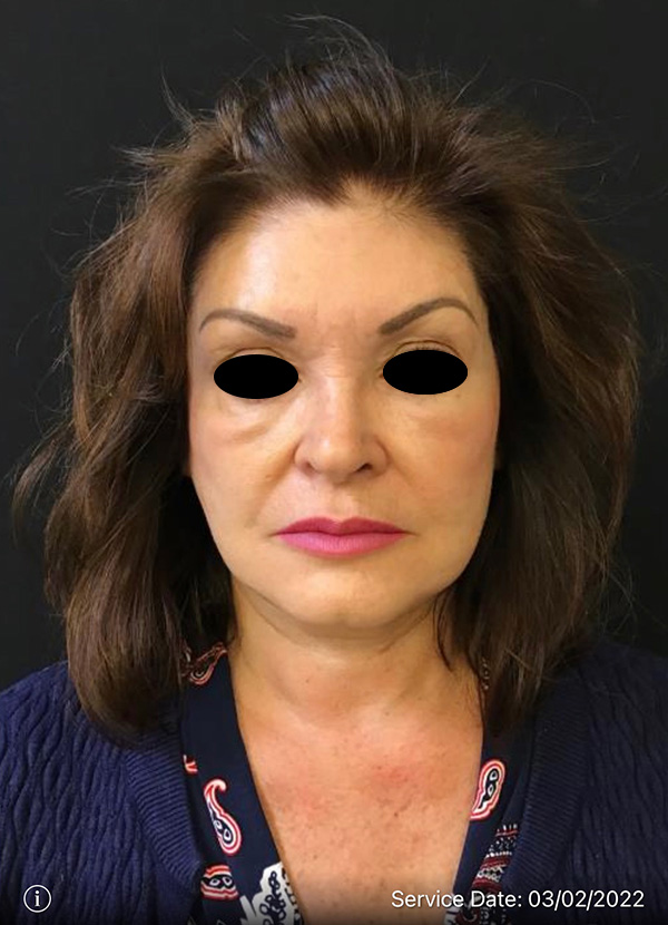 Facelift