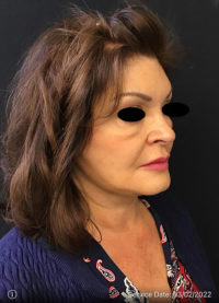 Facelift