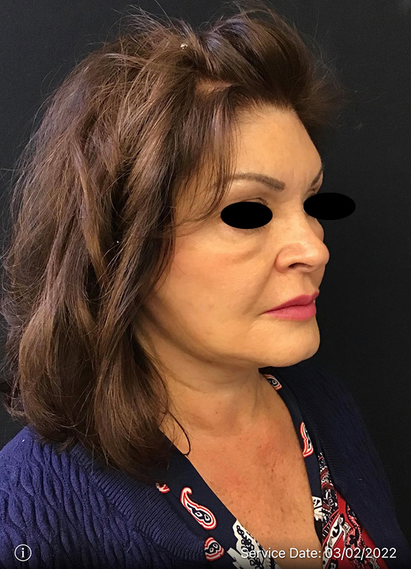 Facelift