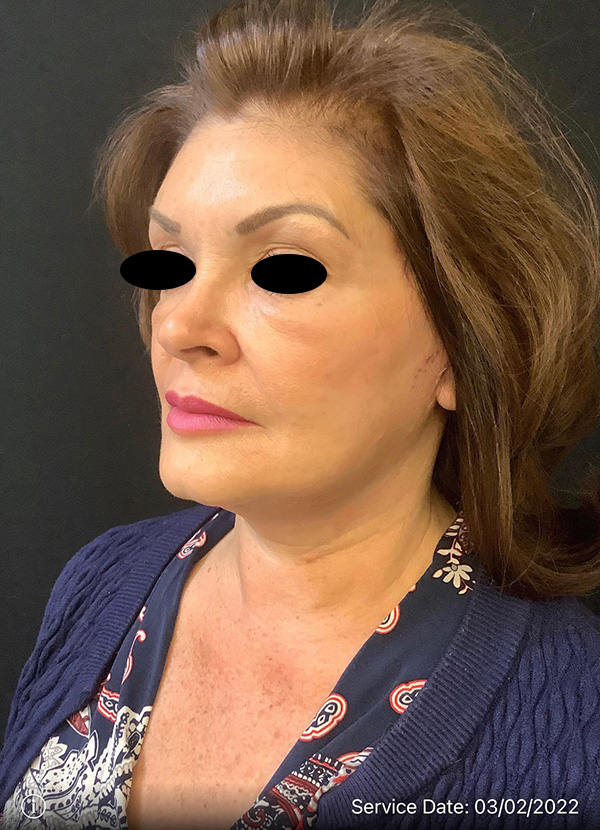 Facelift