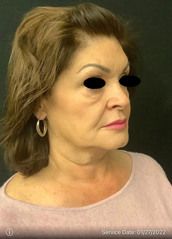 Facelift