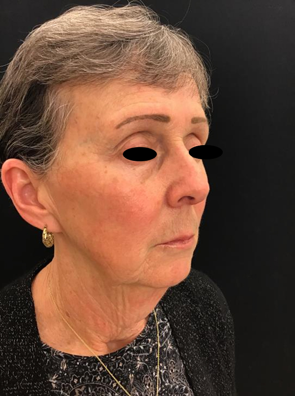 Facetite