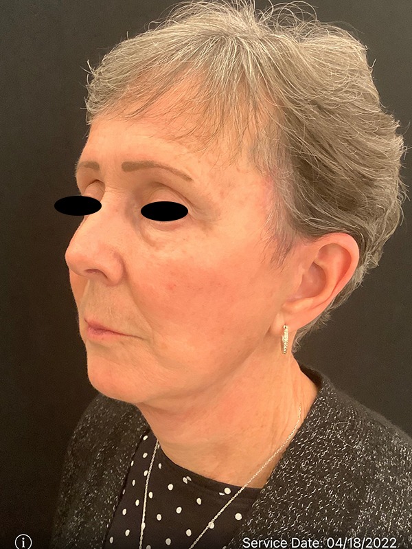 Facetite