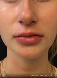 Juvederm