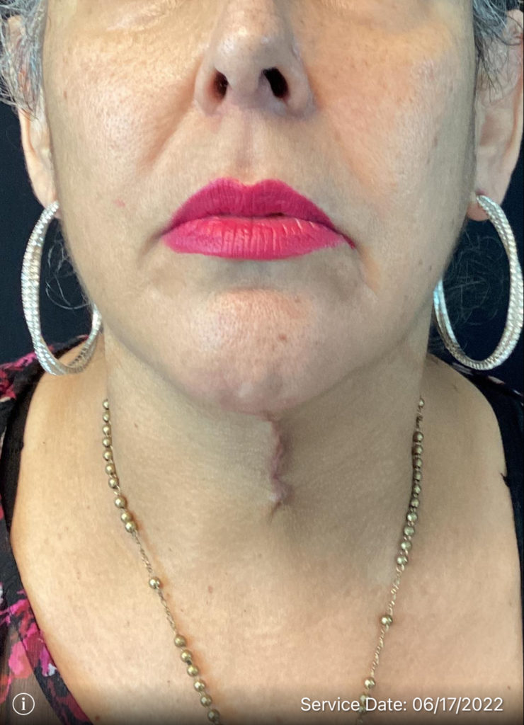 Neck Lift