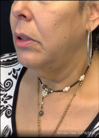 Neck Lift