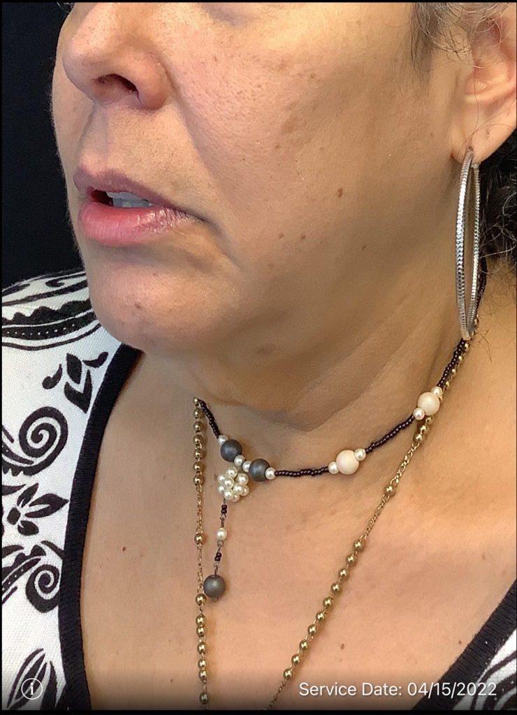 Neck Lift