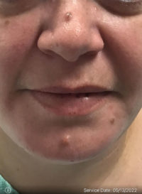 Dermatologic Surgery