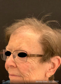 NeoGraft
