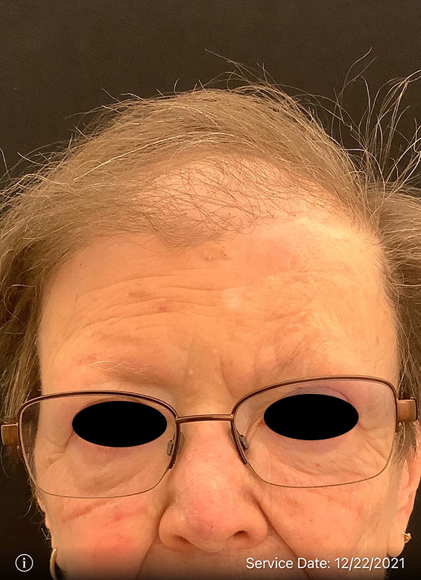 NeoGraft