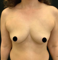 Fat Grafting to Breast