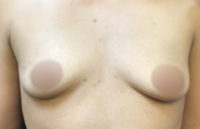 Breast Augmentation