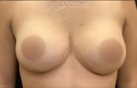 Breast Augmentation