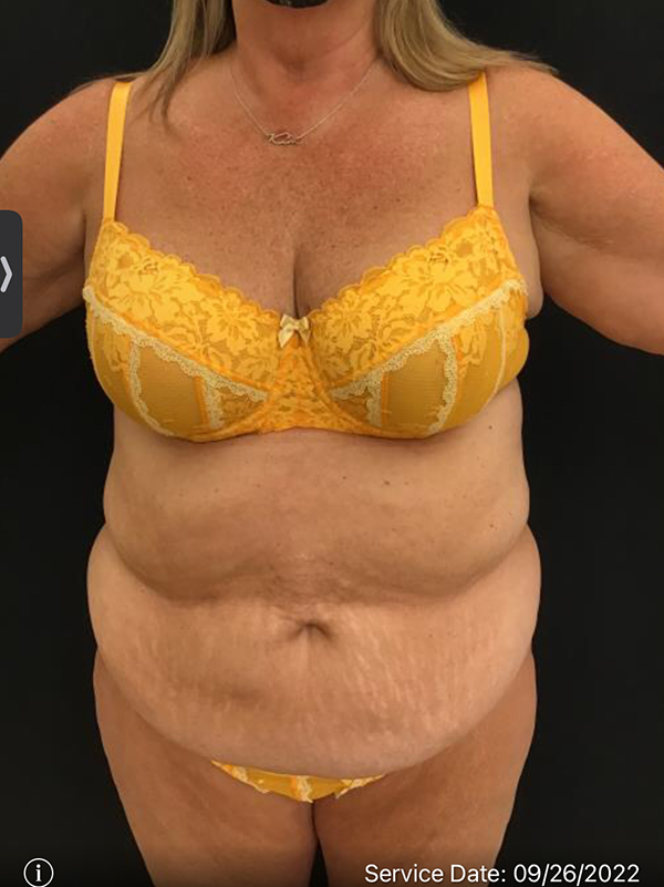 Tummy Tuck