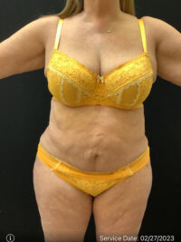 Tummy Tuck