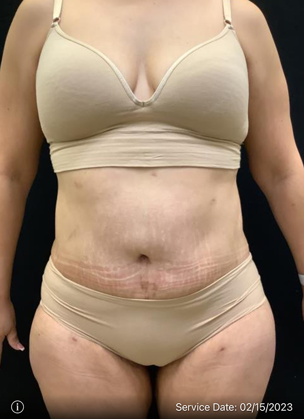 Tummy Tuck