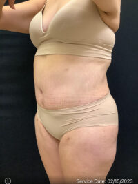 Tummy Tuck
