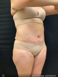 Tummy Tuck
