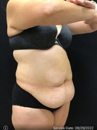 Tummy Tuck