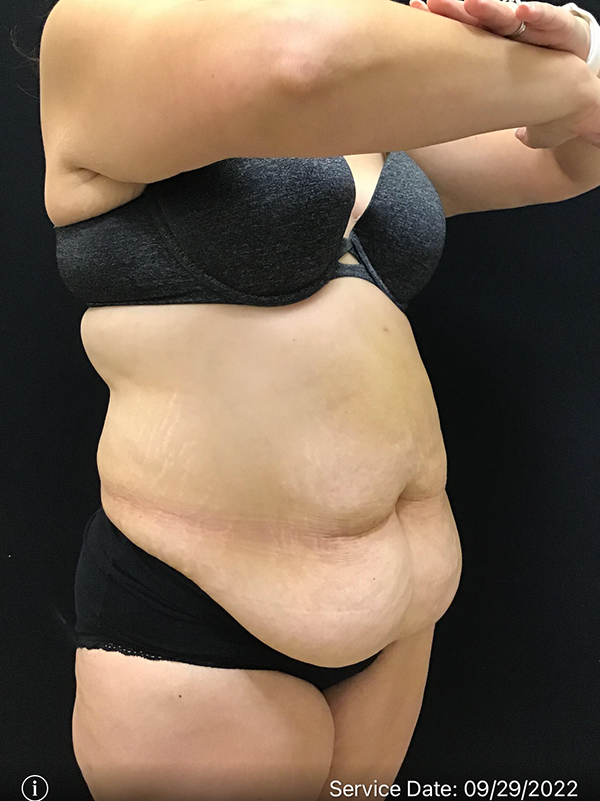 Tummy Tuck