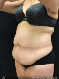 Tummy Tuck