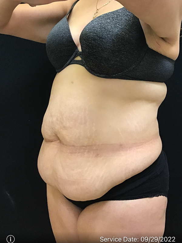 Tummy Tuck