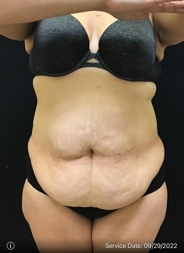 Tummy Tuck