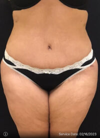 Tummy Tuck