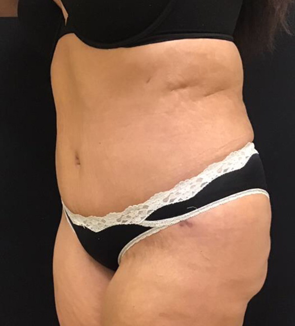 Tummy Tuck