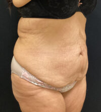 Tummy Tuck