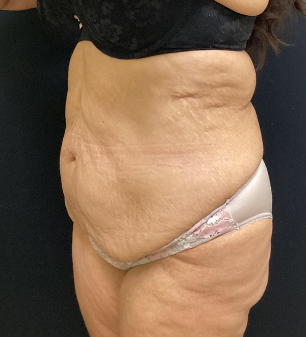 Tummy Tuck