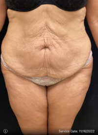 Tummy Tuck