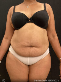 Tummy Tuck