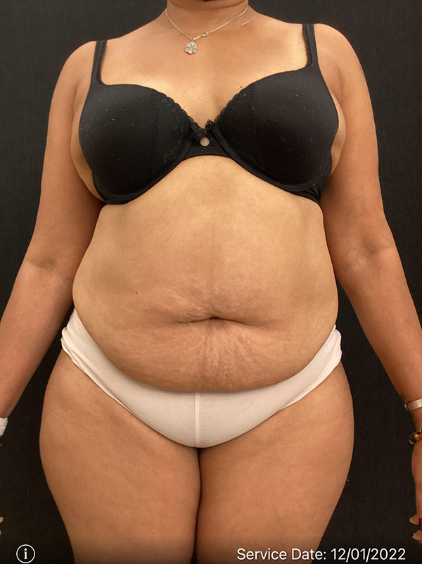 Tummy Tuck