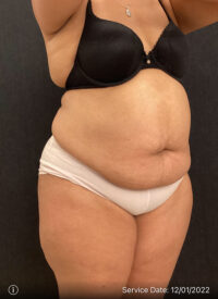 Tummy Tuck