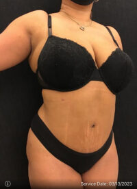 Tummy Tuck