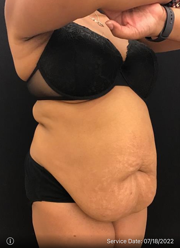 Tummy Tuck