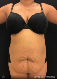 Tummy Tuck