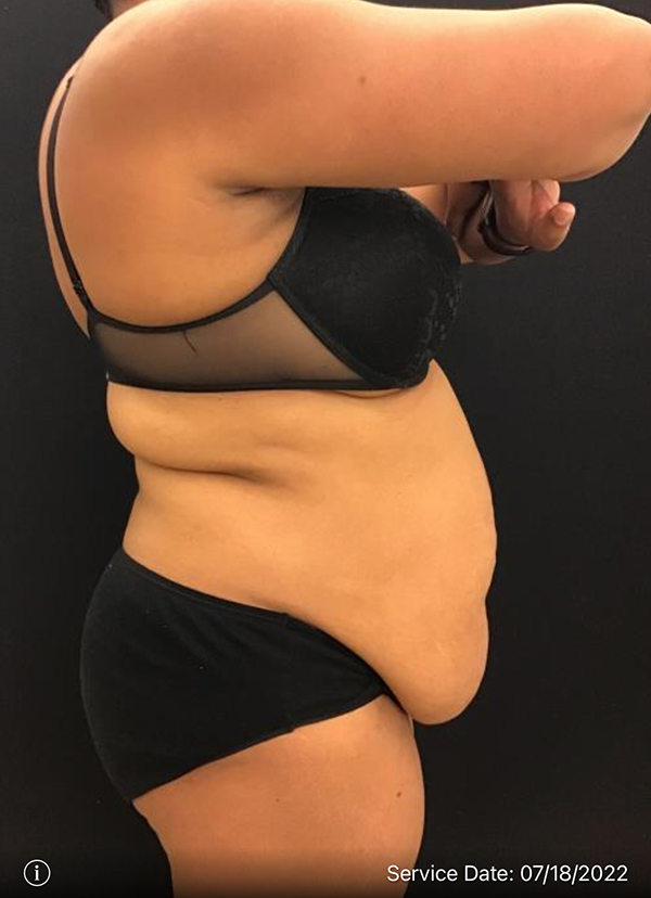 Tummy Tuck