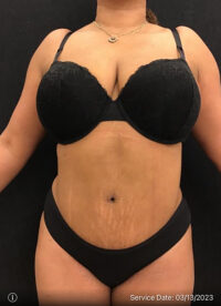 Tummy Tuck