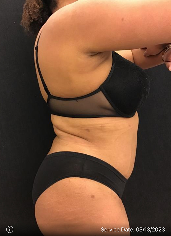 Tummy Tuck