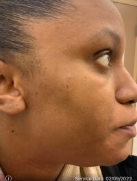 Dermatologic Surgery