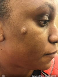 Dermatologic Surgery