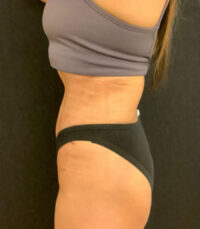 Tummy Tuck