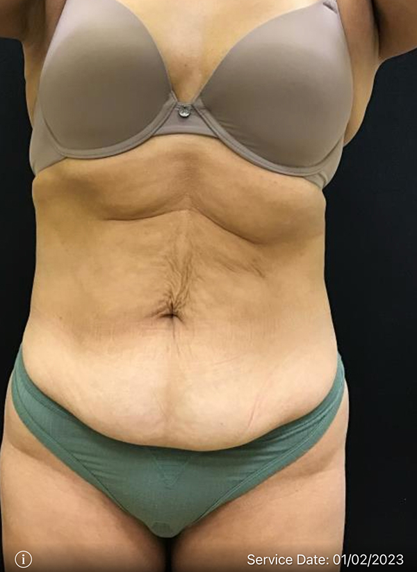 Tummy Tuck