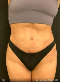 Tummy Tuck