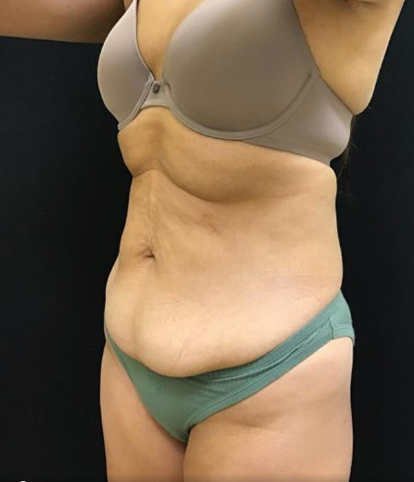 Tummy Tuck