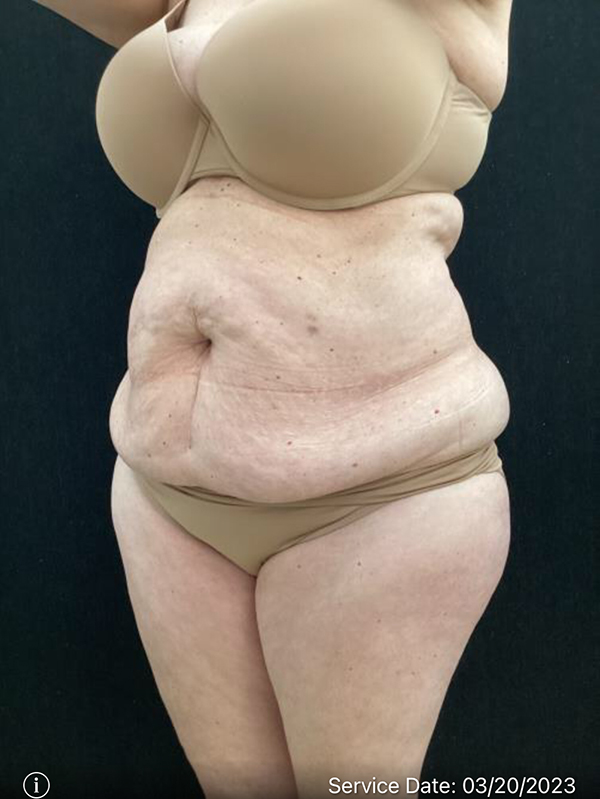 Tummy Tuck