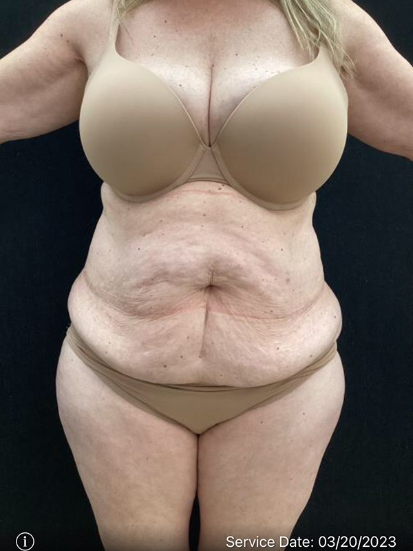 Tummy Tuck